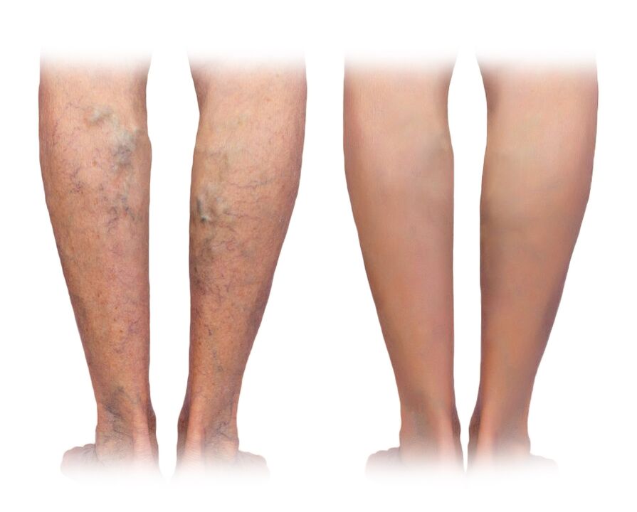 Jambes avec varices avant et après utilisation de la crème Veniselle