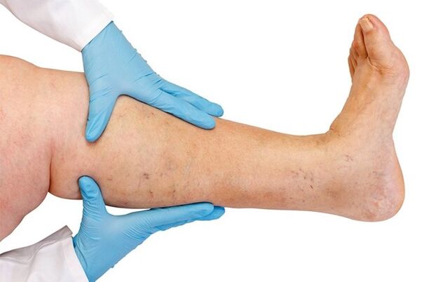 Varices sur les jambes